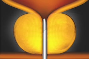 urolift how2