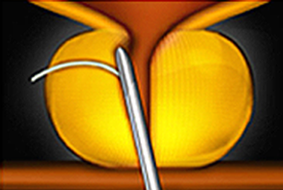urolift how3