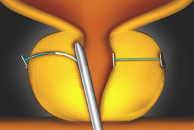 urolift how4