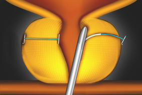 urolift how5